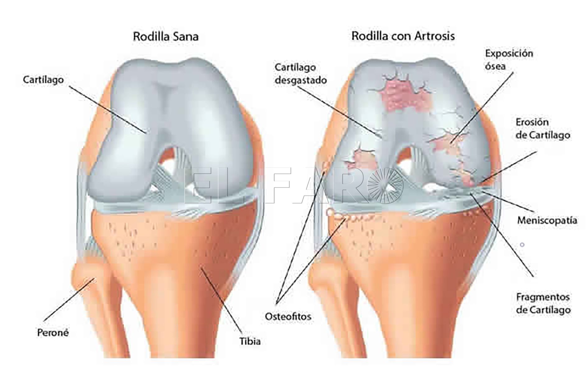 artrosis generalizada tratamentul hemartritei la genunchi