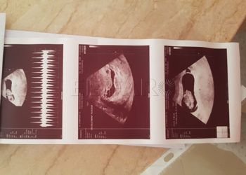 ecografia-embarazada