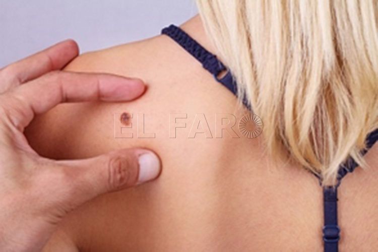 cancer-piel