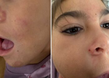 hija-aranada-mordida-cuarta-vez-denuncia-familia-alumna-colegio-san-antonio-2