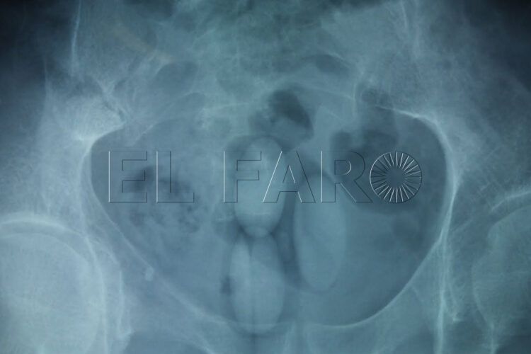 que-ocurre-abre-bellota-hachis-estomago