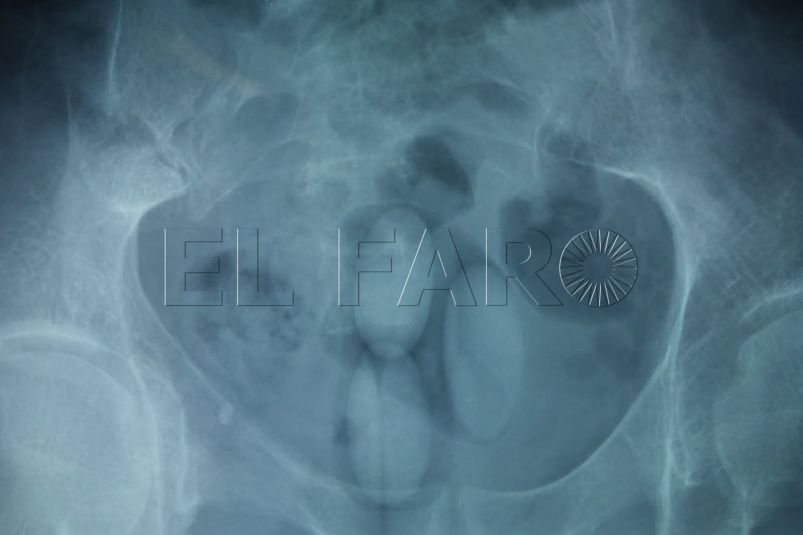 que-ocurre-abre-bellota-hachis-estomago