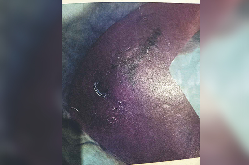 madre-pide-ingesa-responsabilidades-fractura-osea-anos